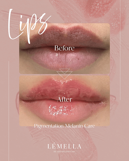 Lips Before/After